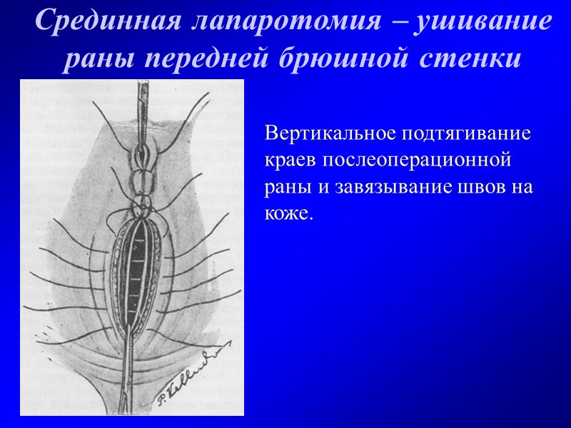 Срединная лапаротомия – ушивание раны передней брюшной стенки Вертикальное подтягивание краев послеоперационной раны и